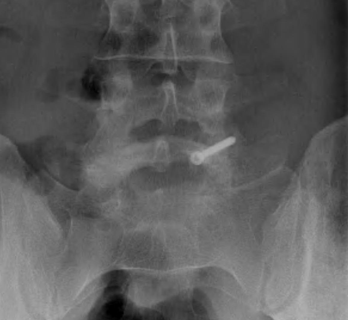 Lytic Pars Defect Unilateral Pars Screw0001